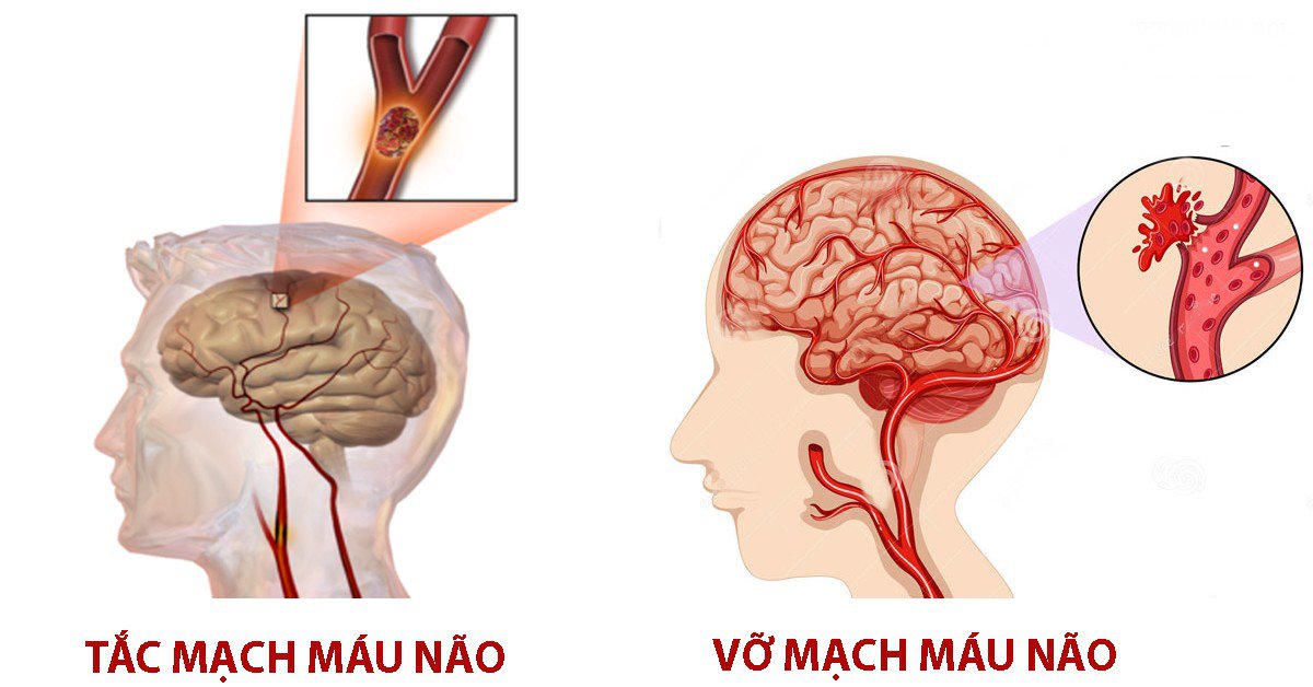 Điều Trị Phục Hồi Chức Năng Cho Người Bị Tai Biến Mạch Máu Não